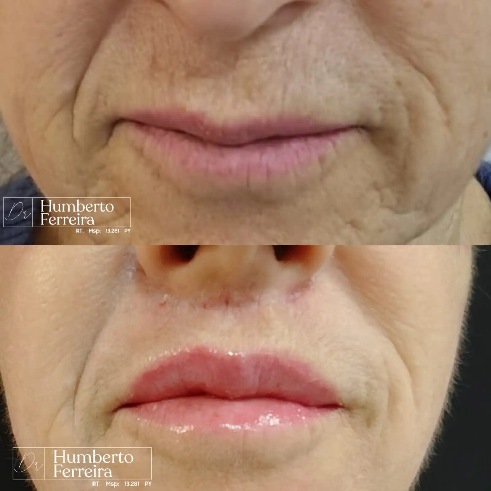 Resultado de paciente 8: Antes y Después