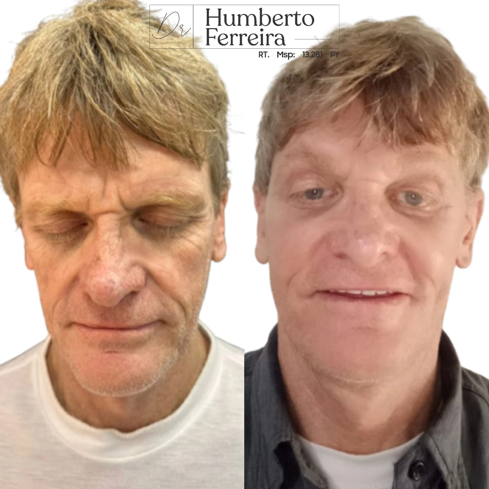 Resultado de paciente 1: Antes y Después