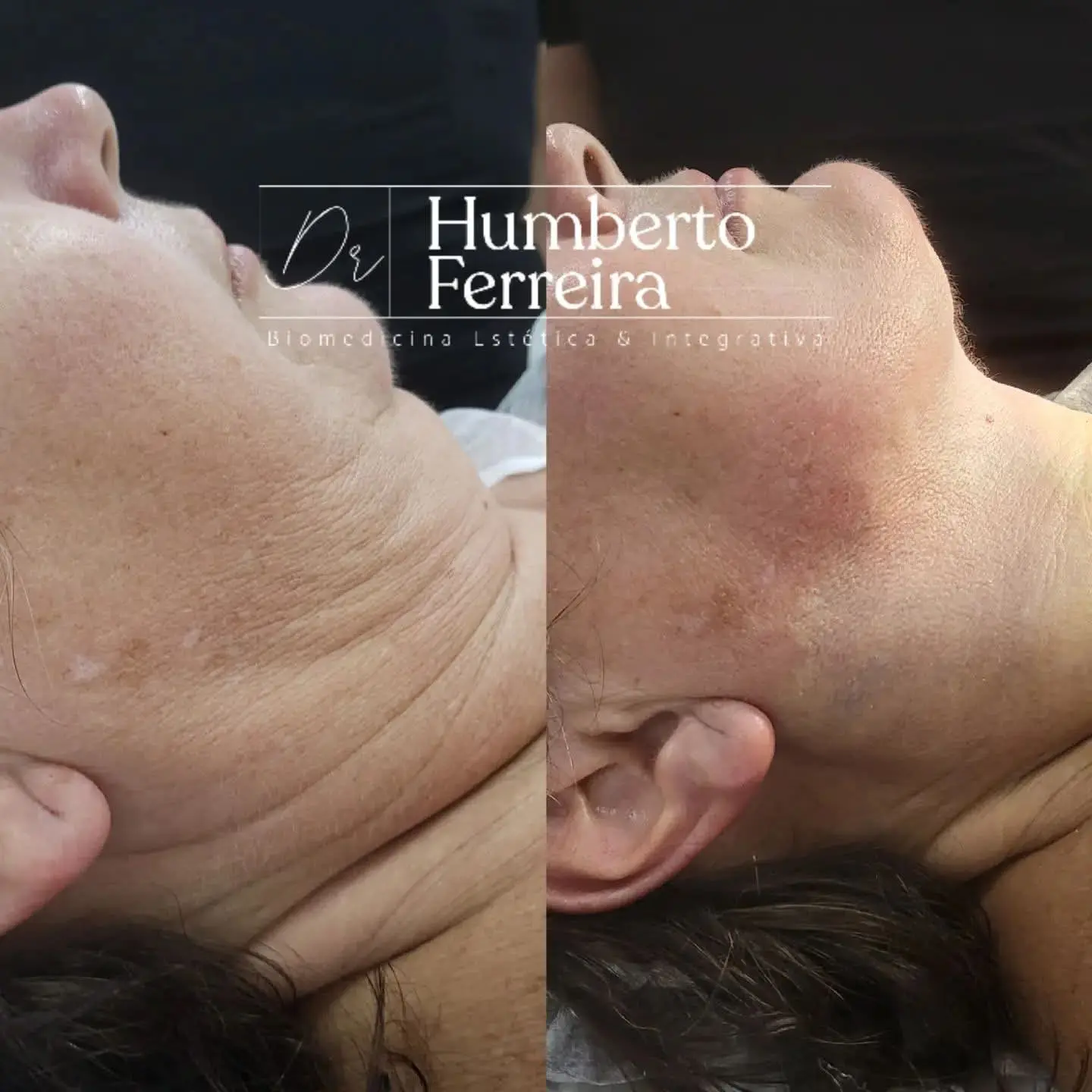 Resultado de paciente 2: Antes y Después