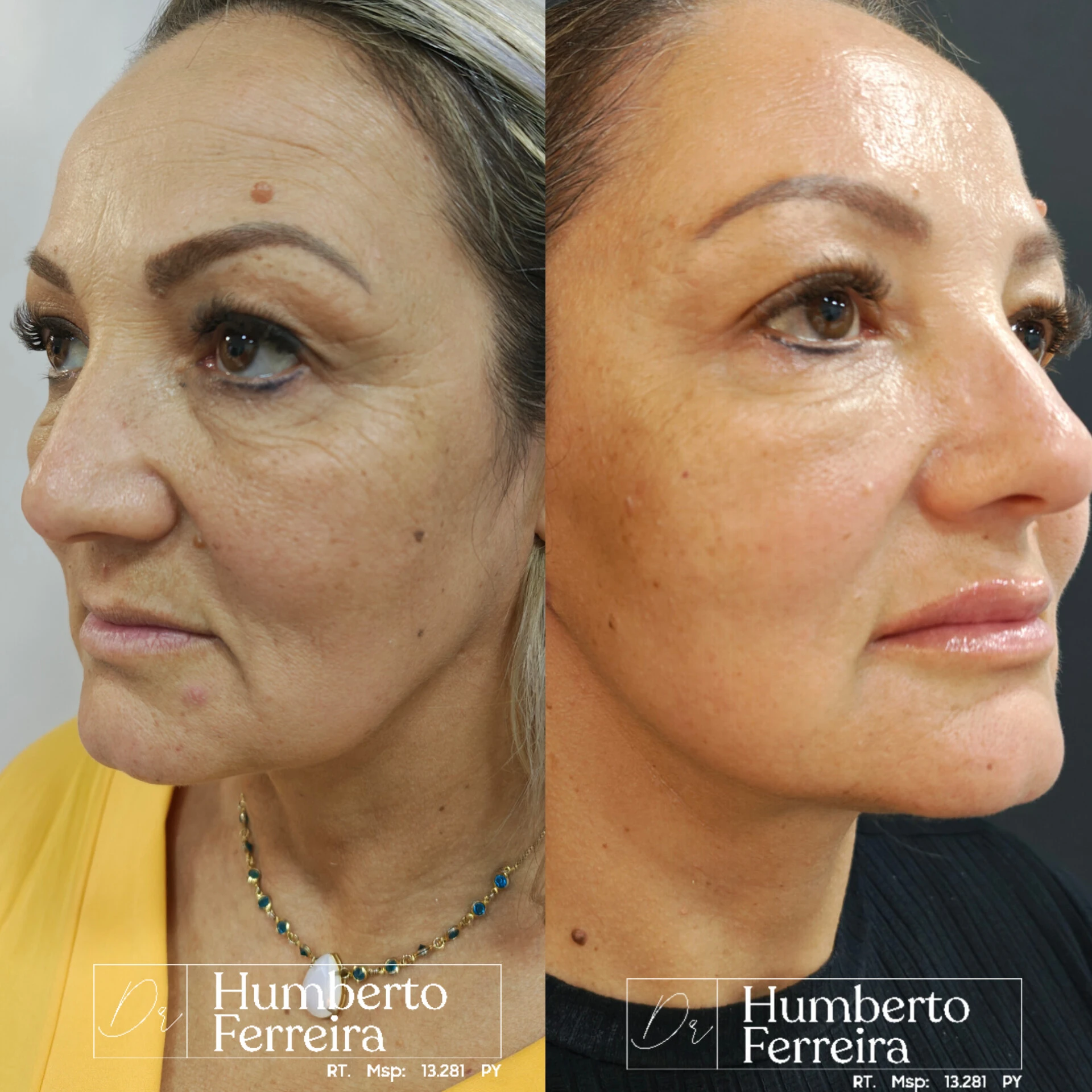 Resultado de paciente 3: Antes y Después