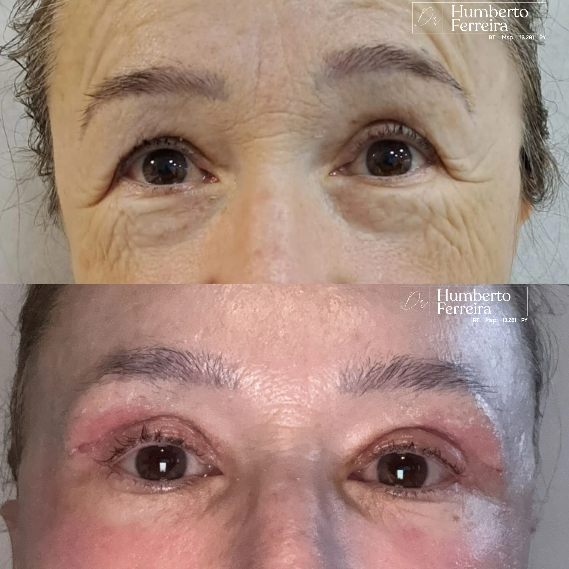 Resultado de paciente 4: Antes y Después