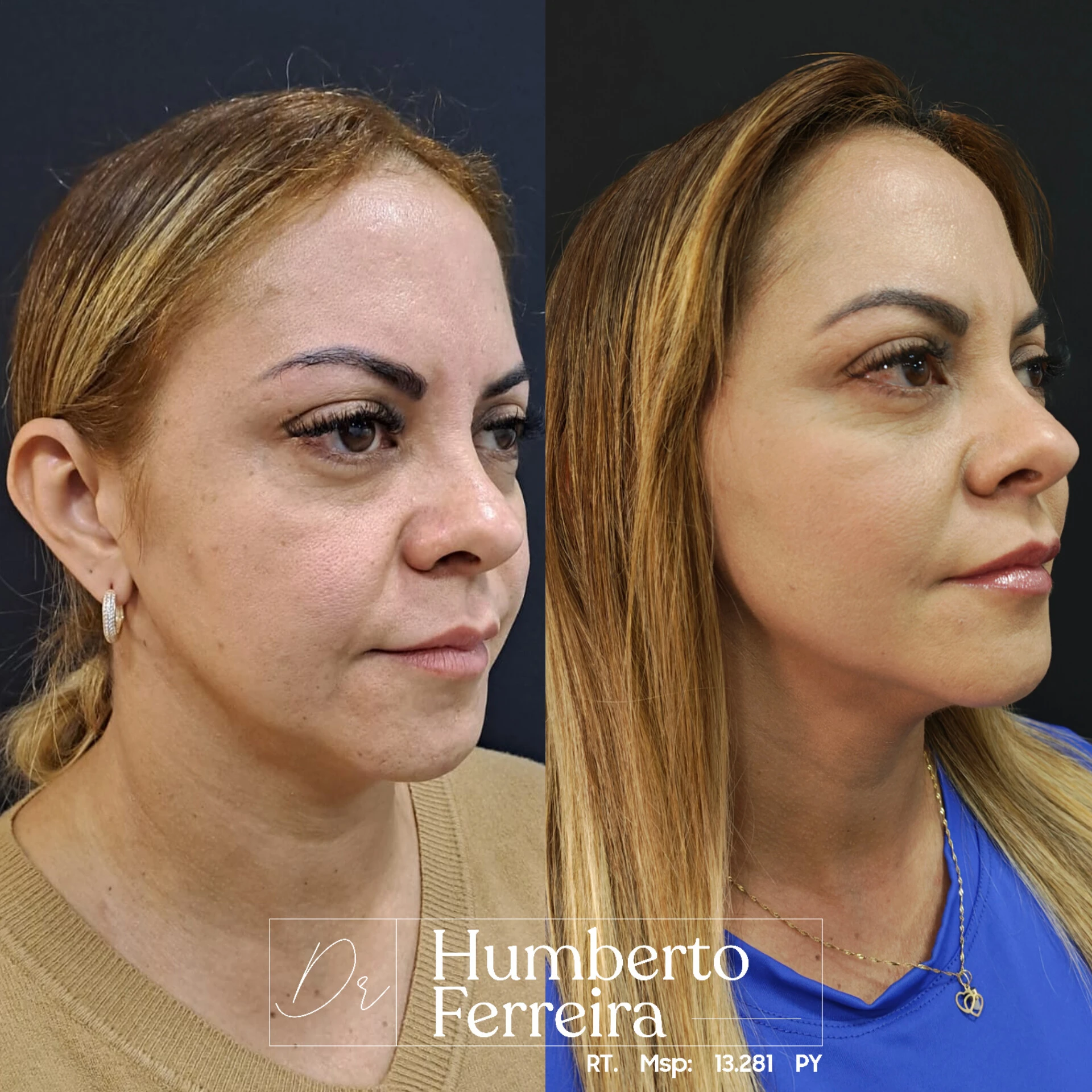 Resultado de paciente 5: Antes y Después