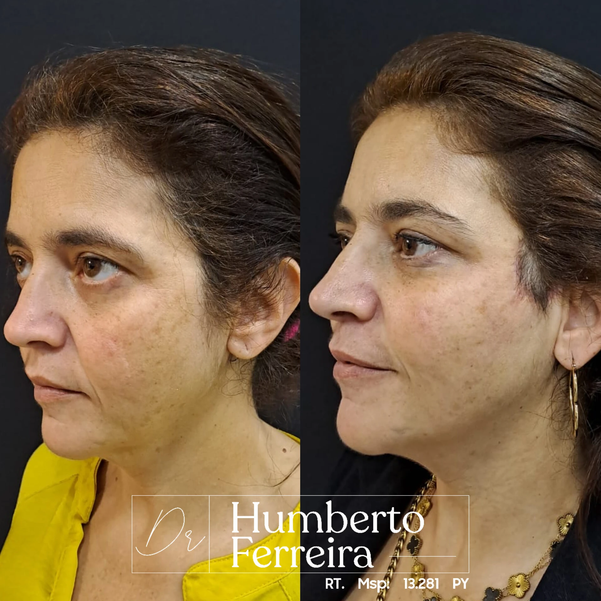 Resultado de paciente 6: Antes y Después