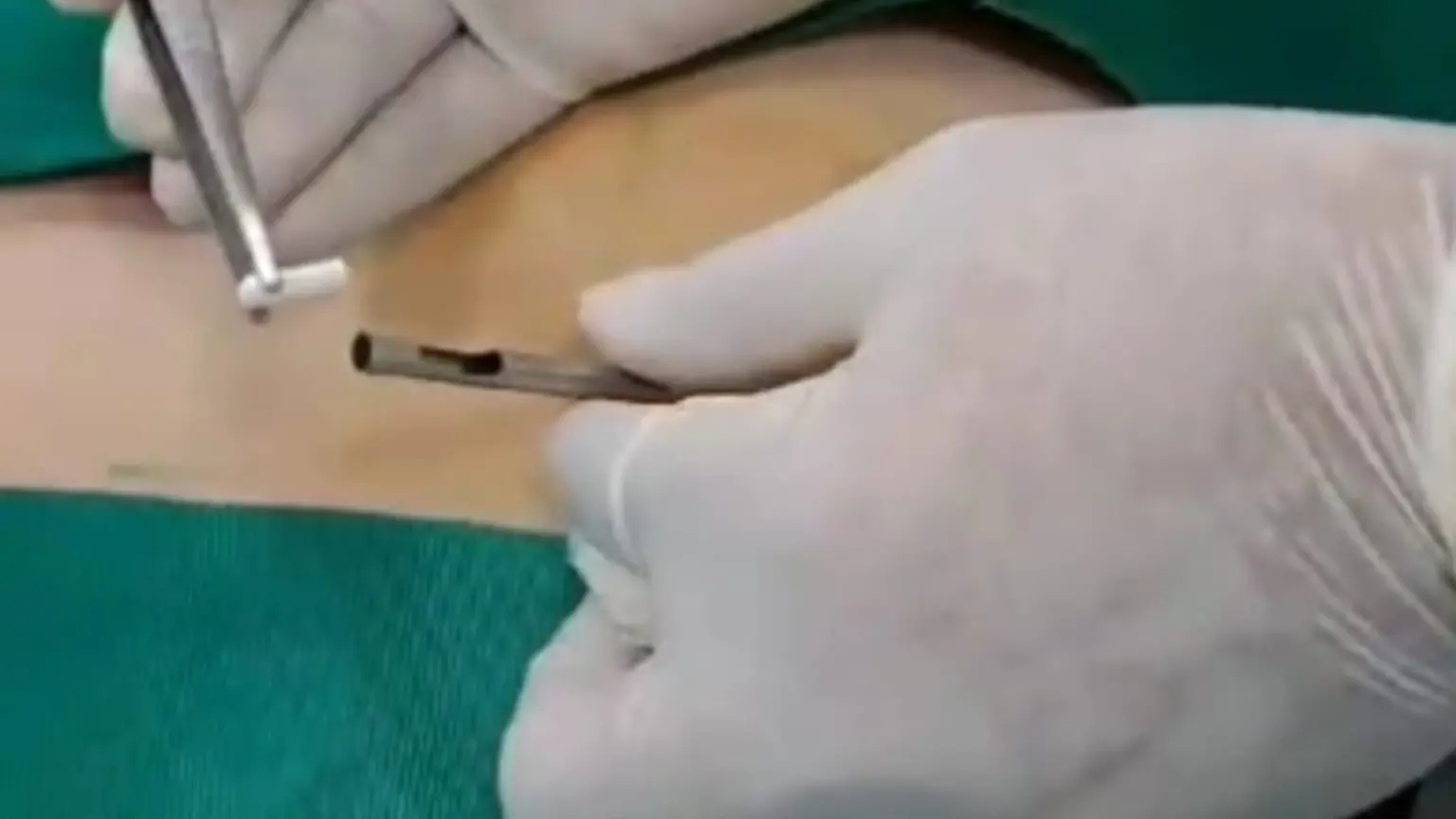 Implantes Hormonales