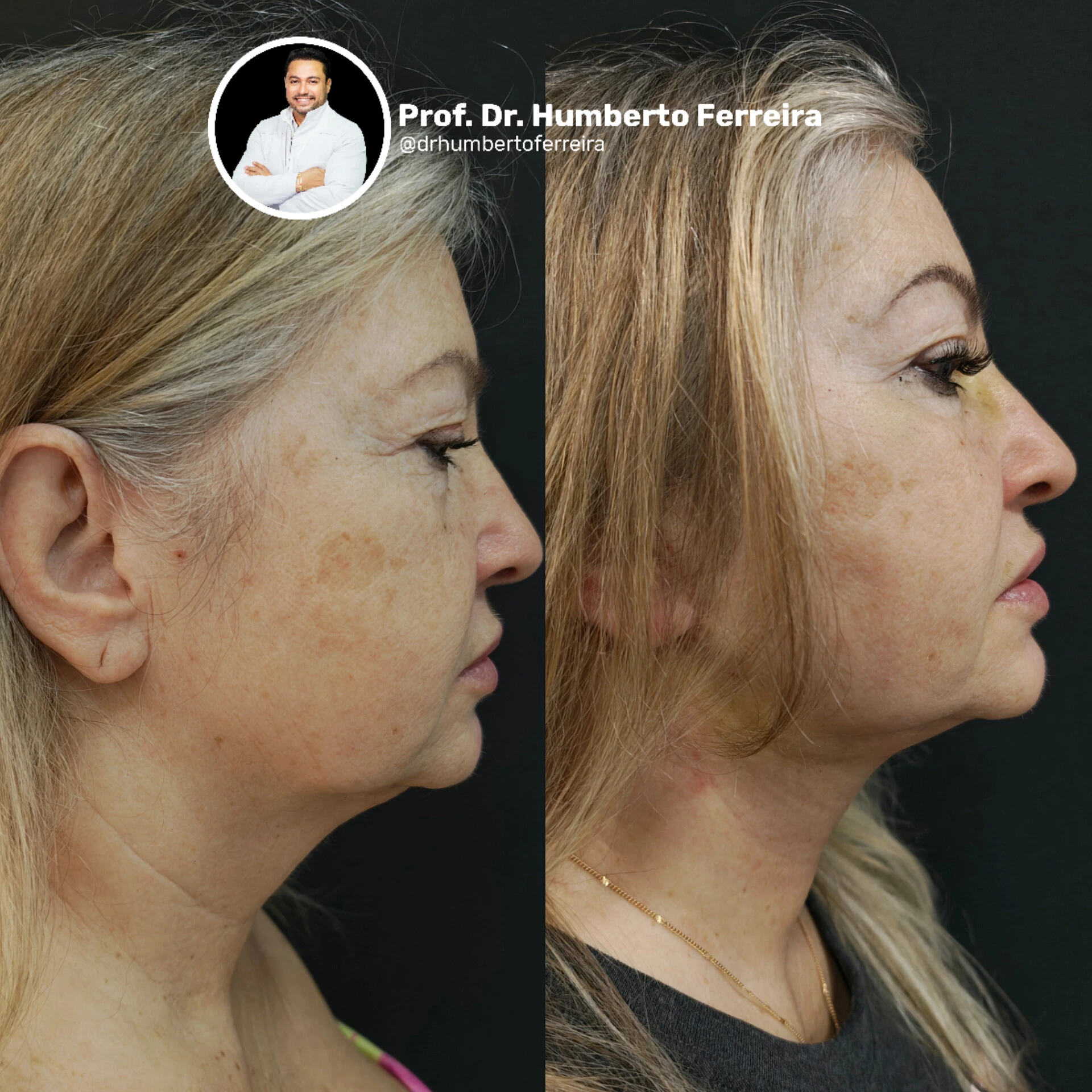 Resultado de paciente 10: Antes y Después