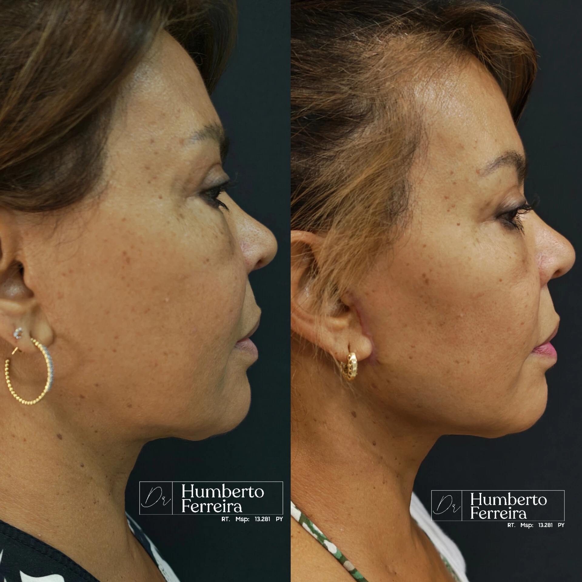 Resultado de paciente 11: Antes y Después