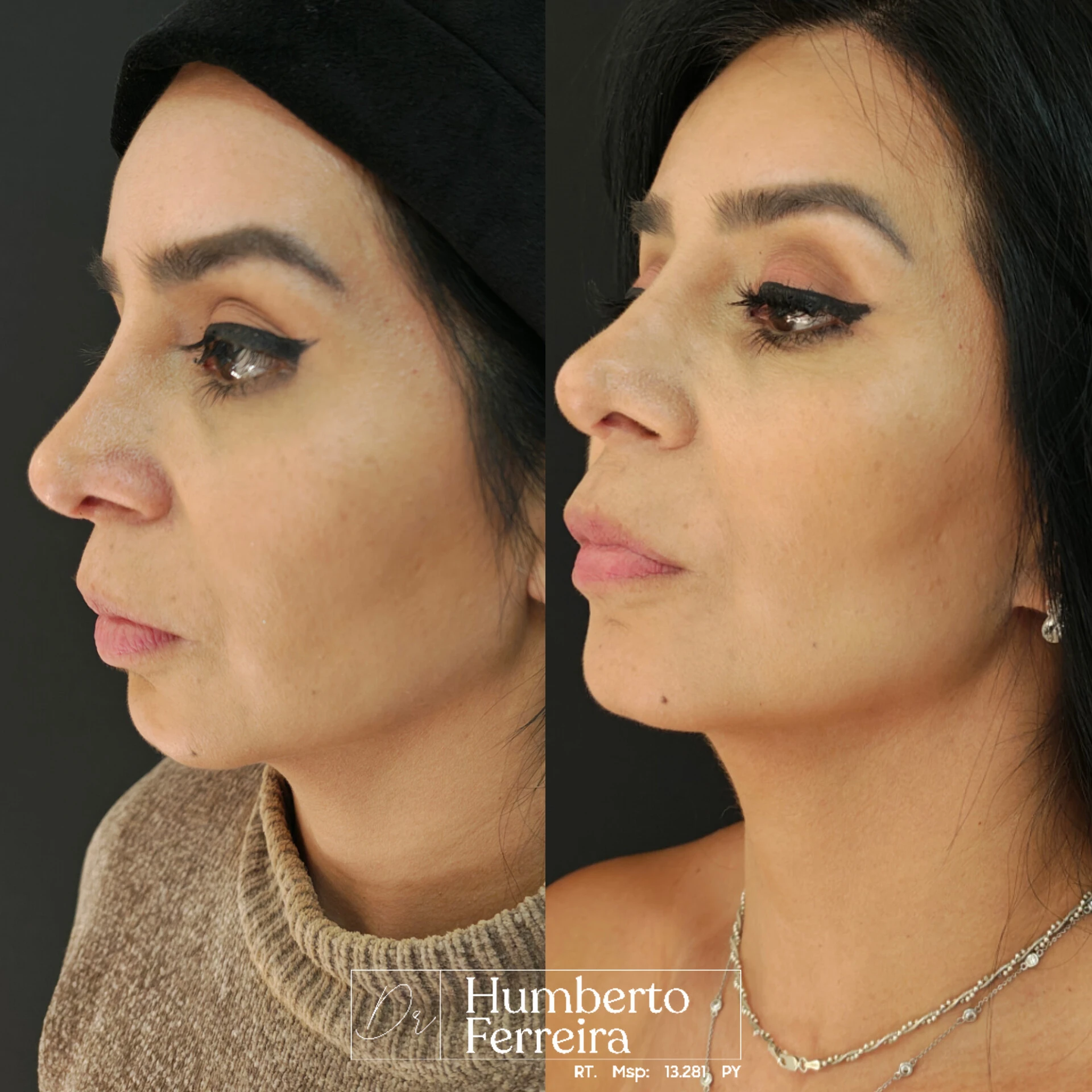 Resultado de paciente 12: Antes y Después