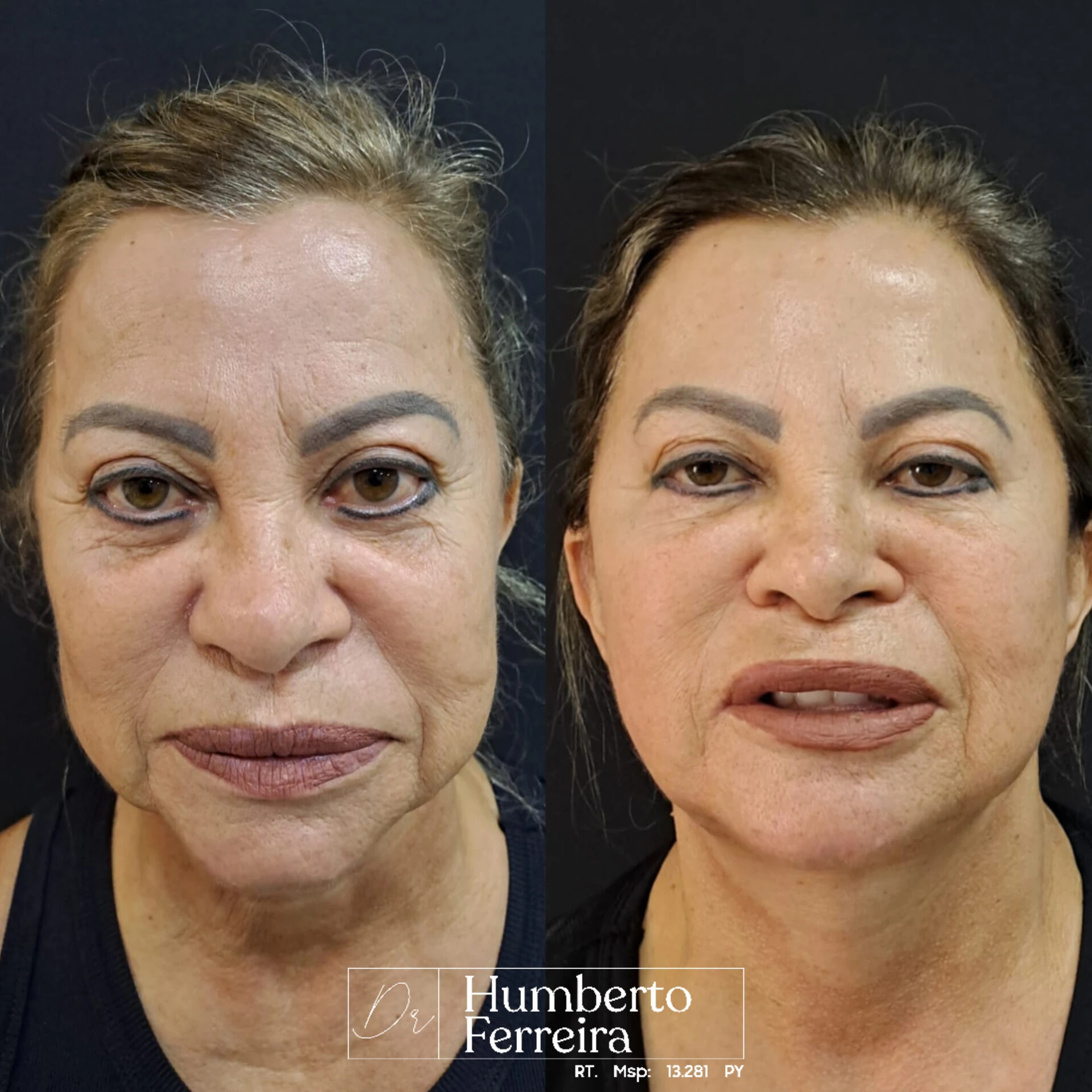 Resultado de paciente 13: Antes y Después