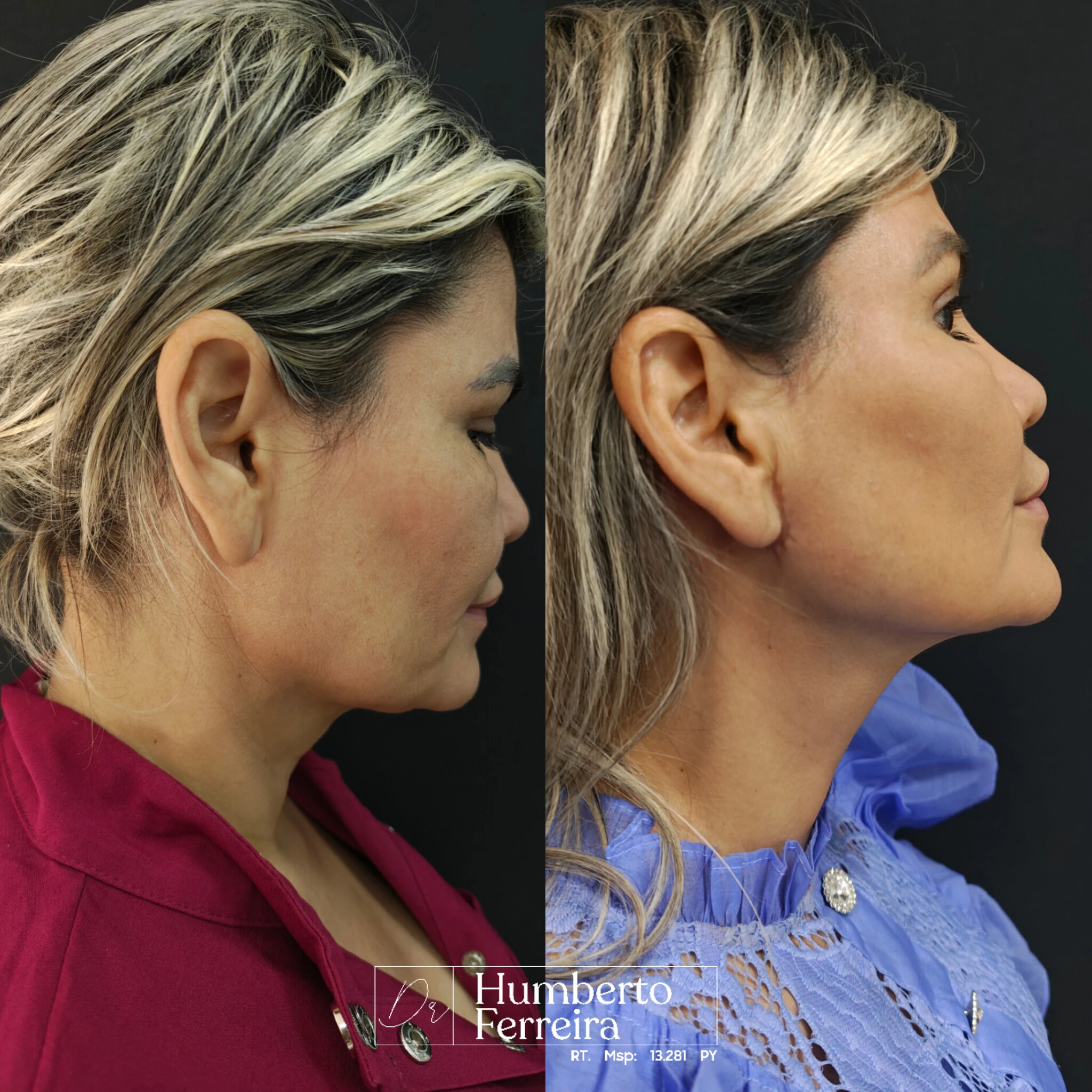 Resultado de paciente 14: Antes y Después